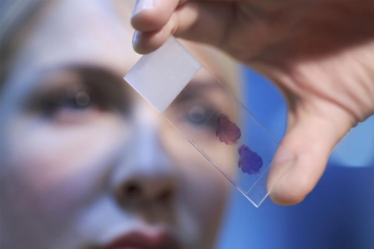 Scientists confirm blood test could track Alzheimer's disease