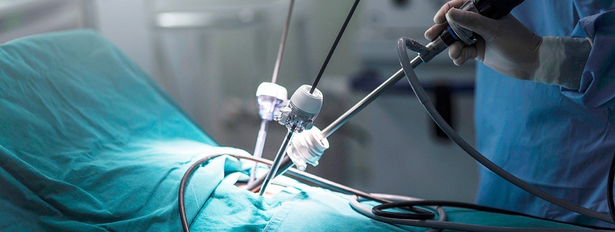 Laparoscopy